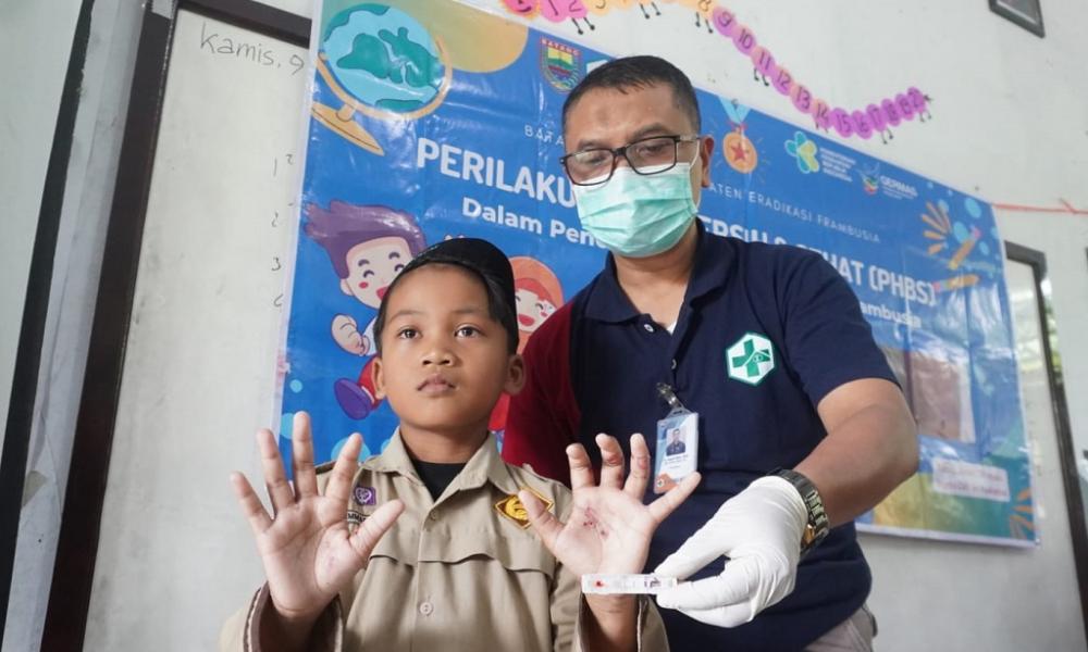 Targetkan Zero Frambusia, Dinkes Skrining dan Edukasi Seluruh Anak